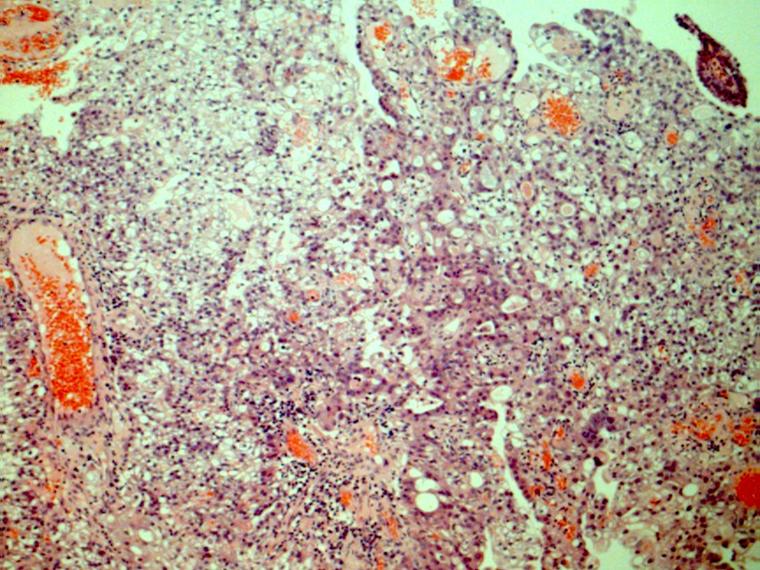 Uterine clear cell carcinoma